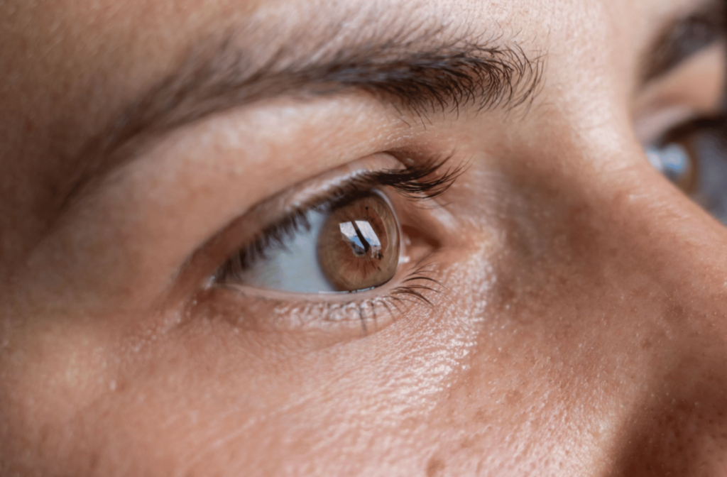 A close-up view of a woman's eye with keratoconus present.